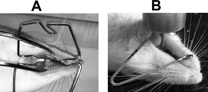 Figure 1. (A) Inserted NiTi coil spring. (B) Application of low-frequency mechanical vibration on maxillary right first molar.