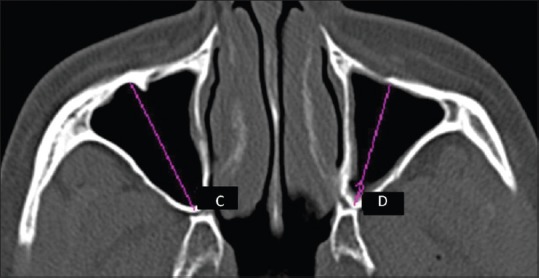 Sex Determination Using Maxillary Sinus Pmc