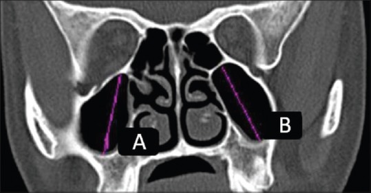 Sex Determination Using Maxillary Sinus Pmc