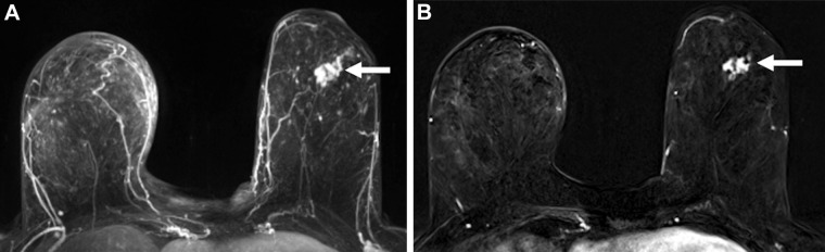 Images in a 60-year-old woman with left breast ductal carcinoma in situ who underwent successful wide local excision after similar extent of disease was seen on MRI scans. (A) Maximum intensity projection and (B) first postcontrast axial T1-weighted subtraction images show an enhancing mass (arrow) measuring 27 mm in the lower outer quadrant. Span of disease measured 27 mm at mammography.