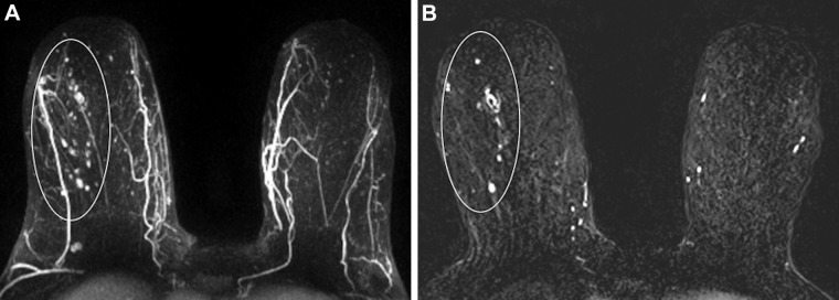 Images in a 72-year-old woman with right breast ductal carcinoma in situ who underwent successful wide local excision after greater extent of disease was seen on MRI scans. (A) Maximum intensity projection and (B) first postcontrast axial T1-weighted subtraction images show segmental nonmass enhancement (oval outline) measuring 100 mm in the upper outer quadrant. Span of disease measured 48 mm at mammography.