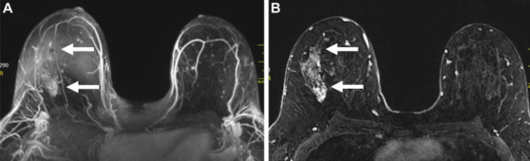 Images in a 46-year-old woman with right breast ductal carcinoma in situ who underwent mastectomy after a greater extent of disease was seen on MRI scans. (A) Maximum intensity projection and (B) first postcontrast axial T1-weighted subtraction images show segmental nonmass enhancement (arrows) measuring 70 mm in the upper outer quadrant of the right breast. Span of disease measured 30 mm at mammography.