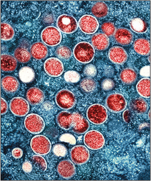 Coloured transmission electron micrograph (TEM) of monkeypox virus particles (red) found within an infected cell (blue), cultured in the laboratory. Monkeypox particles are composed of a DNA (deoxyribonucleic acid) genome surrounded by a protein coat and lipid envelope. This virus, which is found near rainforests in Central and West Africa causes disease in humans and monkeys, although its natural hosts are rodents. It is capable of human to human transmission. In humans it causes fever, swollen glands and a rash of fluid-filled blisters. It is fatal in 10 per cent of cases. Image obtained at the NIAID Integrated Research Facility (IRF) in Fort Detrick, Maryland, USA.