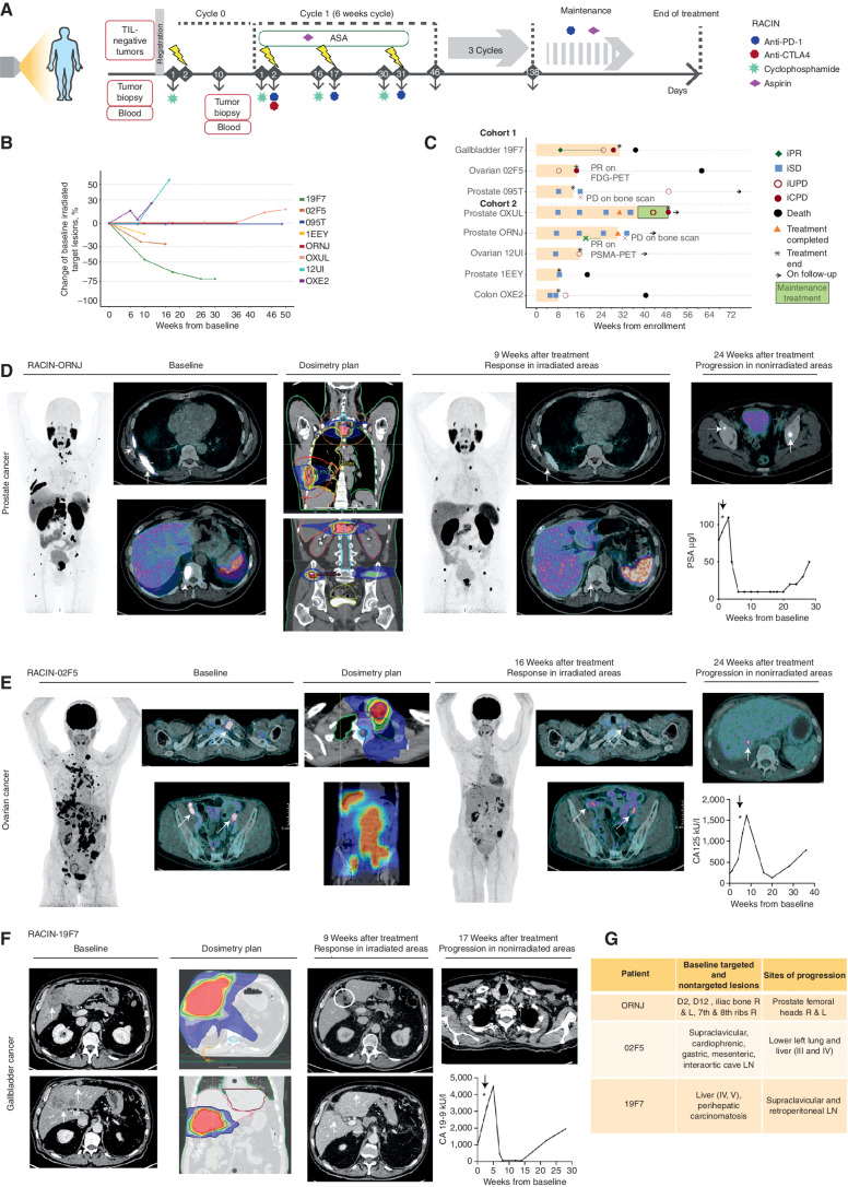 Figure 5. Low-dose irradiation plus ICB induces responses in advanced human immune-desert tumors. A, Therapeutic schema of the phase I RACIN study. B, Spider plot depicts the percentage change in the sum of targeted irradiated metastases compared with baseline. C, Swimmer plot depicts patients' response to RACIN over time; each bar, one patient; light orange, time on combination treatment; green, time on maintenance treatment; cohort 1: 0.5 Gy, cohort 2: 1 Gy; orange triangles, completed treatment; asterisk, treatment termination due to toxicity or progression; black circles, death. iRECIST v1.1 was used to indicate PR (iPR, green diamond), SD (iSD, light blue square), confirmed progressive disease (iCPD, maroon circle), or unconfirmed (iUPD, maroon empty circle). D, 68Ga-PSMA PET/CT images of irradiated tumors (white arrows) before and after treatment from a patient with metastatic castration-resistant prostate cancer having SD according to Prostate Cancer Clinical Trials Working Group 3 (PCWG3) but an important response on 68Ga-PSMA PET/CT images. Changes in PSA tumor marker. Progression observed outside the irradiated areas 24 weeks after treatment initiation. E, 18FDG-PET/CT images of irradiated tumors (white arrows) before and after treatment from a patient with high-grade serous ovarian carcinoma having by iRECIST iPD, but an important response on 18FDG-PET/CT imaging. Changes in the CA125 tumor marker. Progression outside the irradiated areas 24 weeks after treatment initiation. F, CT images of irradiated tumors (white arrows and circles) before and after treatment from a patient with gallbladder cancer having PR by iRECIST and 70% reduction from baseline in targeted irradiated lesions. Changes in the CA 19-9 tumor marker. Progression outside the irradiated areas 17 weeks after treatment initiation. G, Anatomic location of irradiated target and nontargeted lesions in responder patients and the anatomical location of tumor recurrence (D2, second dorsal vertebrae; D12, dorsal 12; R, right; L, left; LN, lymph node; liver segments identified with roman numbers III, IV, and V).