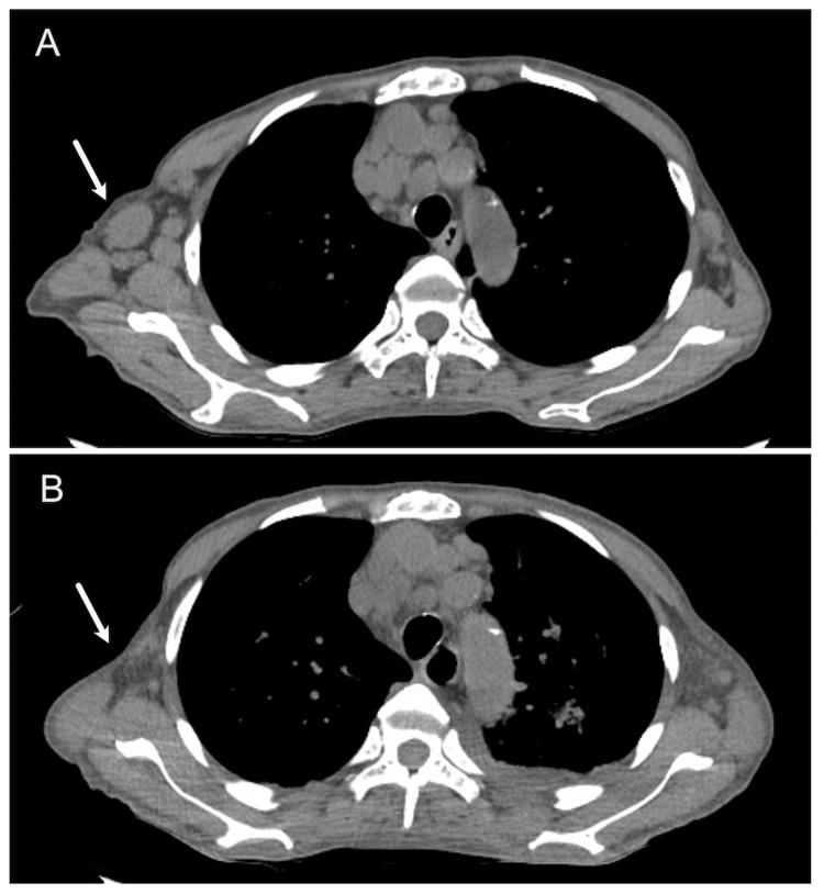 Epstein Barr Virus Related Lymphoproliferative Disorder In A Patient