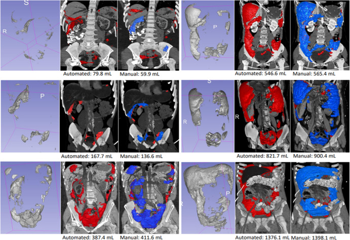 Six high-performing cases are shown with ground truth (manual) volumes ranging from 59.9 to 1398.1 mL. For each patient, the image on the left provides an unobstructed view of the automated segmentation alone, the middle image shows the segmentation (red) superimposed on three-dimensional CT images, and the image on the right shows the overlay between manual (blue) and automated (red) segmentations. Images show blood distributed along common pathways, including perihepatic and perisplenic regions, paracolic gutters, hepatorenal fossa (Morison pouch), and the intraperitoneal pelvis.