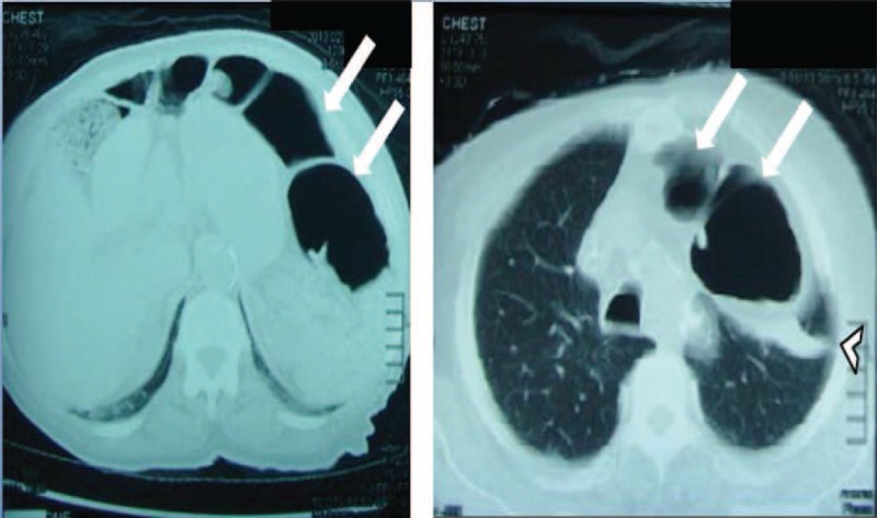 Colon In The Chest: An Incidental Dextrocardia: A Case Report Study - Pmc