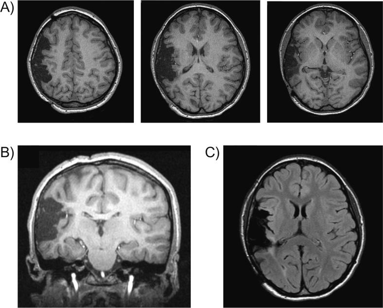 significant-vomiting-and-weight-loss-in-a-pediatric-epilepsy-patient