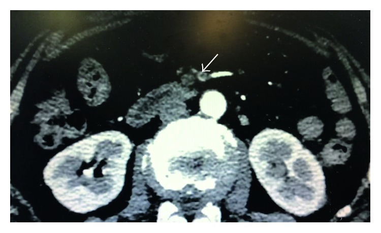 Mesenteric Ischemia And Myocardial Infarction Associated With Atrial 