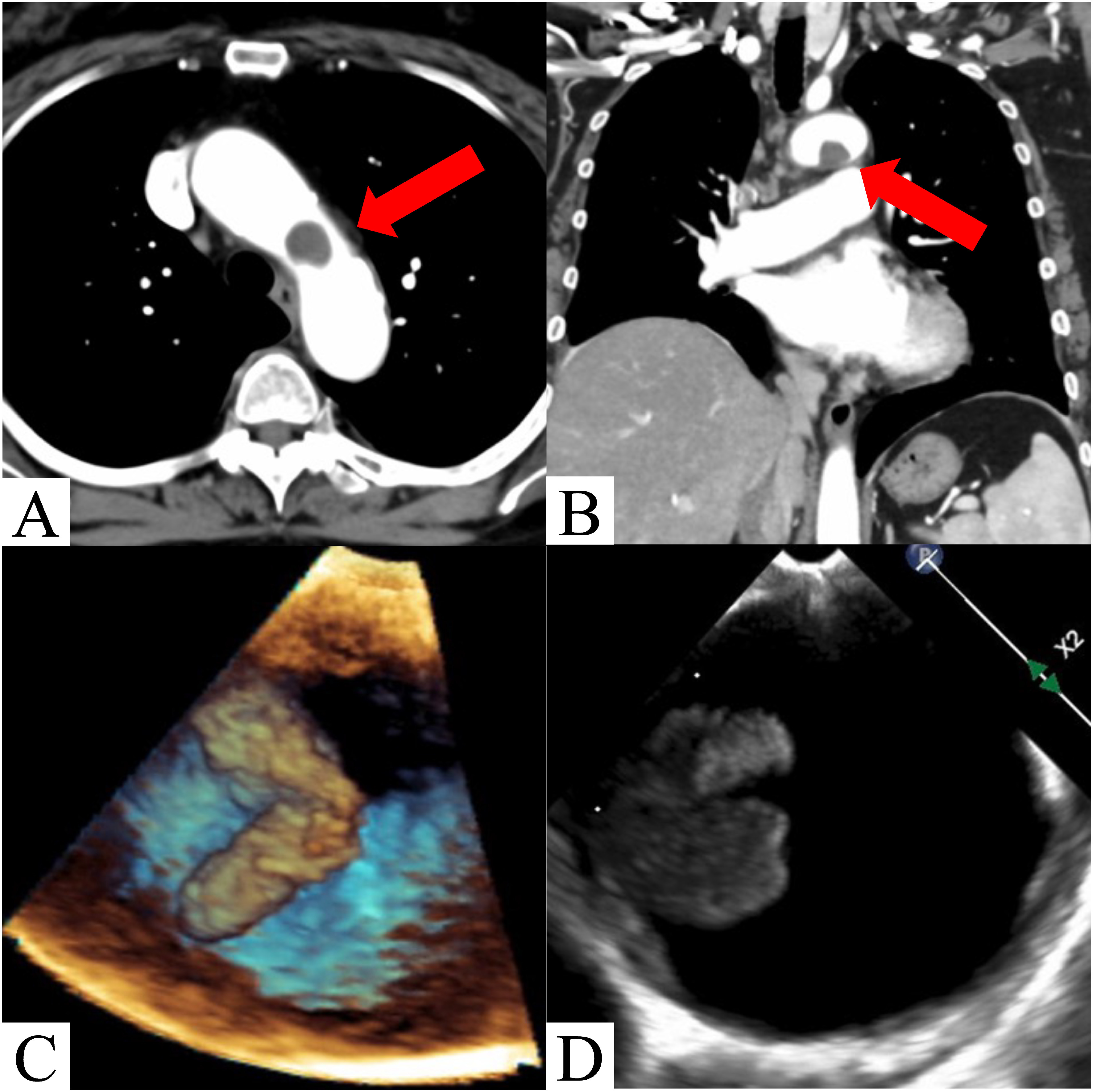 Fig. 1 Contrast-enhanced computed tomography (CT) and transesophageal echocardiography image findings. (A, B) Preoperative contrast-enhanced CT scan shows a 16×12 mm mass in the aortic arch. (C, D) Transesophageal echocardiography shows an approximately 15 mm mobile mass in the aortic arch.