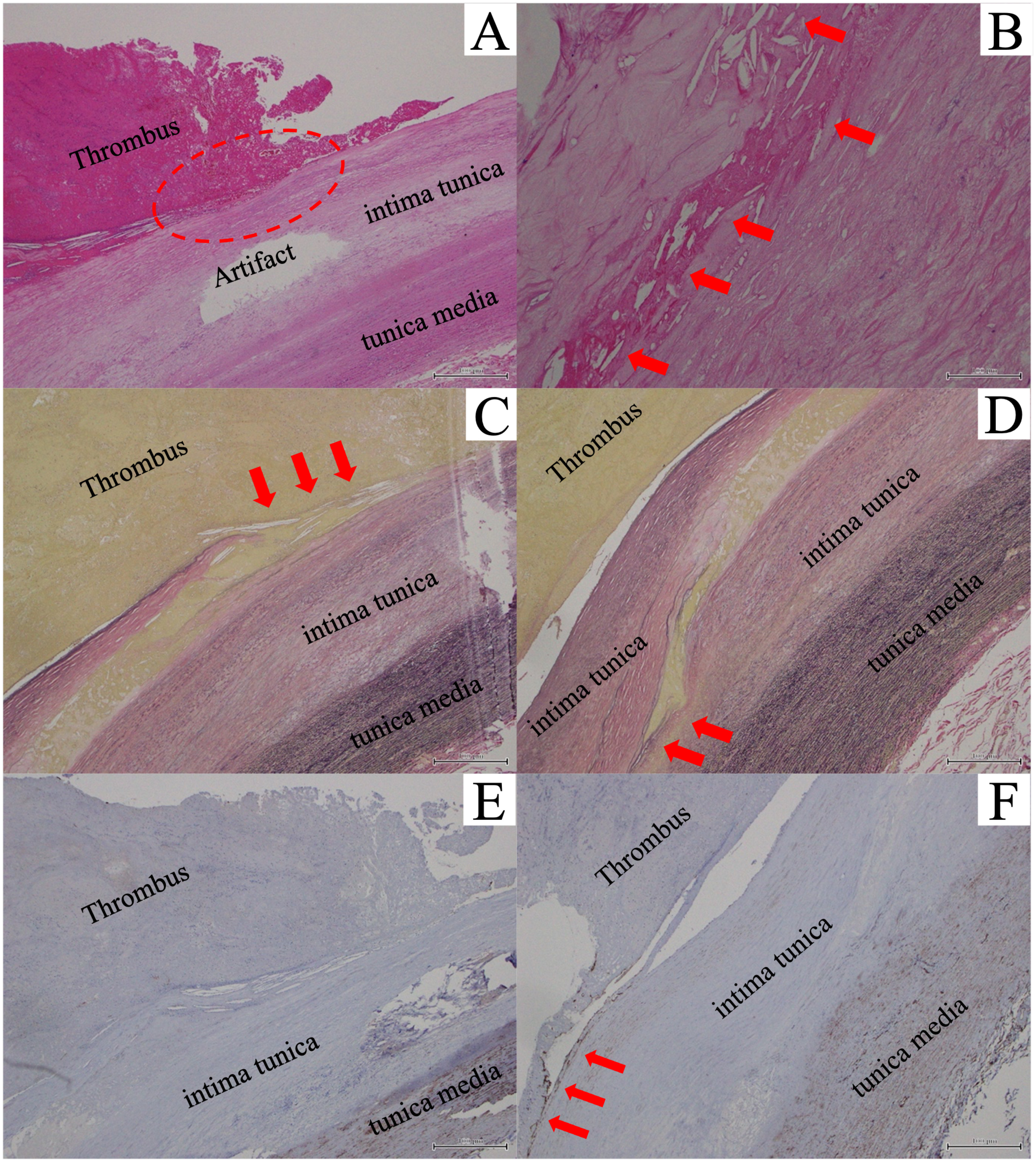 Fig. 3 Pathological findings. (A, B) Hematoxylin and eosin stain of the resected aortic arch with thrombus: (A) Red clots contain red blood cells, fibrin, and white blood cells. The red circled area shows a finding of intimal erosion. (B) The red arrows show cholesterin crystals, which suggest atherosclerosis (A, 40× magnification; B, 400× magnification). (C, D) Elastica van Gieson stain of the resected aortic arch with thrombus: (C) The red arrows show the discontinuity of the intima, which is filled with blood components. (D) The red arrows show the tip of the fissure. The elastic fibers of the tunica media retain their structure, suggesting that the damage is confined to the intima tunica only (C and D, 100× magnification). (E, F) CD34 immunostaining. (E) No positive CD34 staining of cells in the vascular intima. (F) The red arrows show CD34-positive endothelial progenitor cells (CD34+ endothelial progenitor cells) only on the edge of the thrombus (E, 40× magnification; F, 100× magnification).