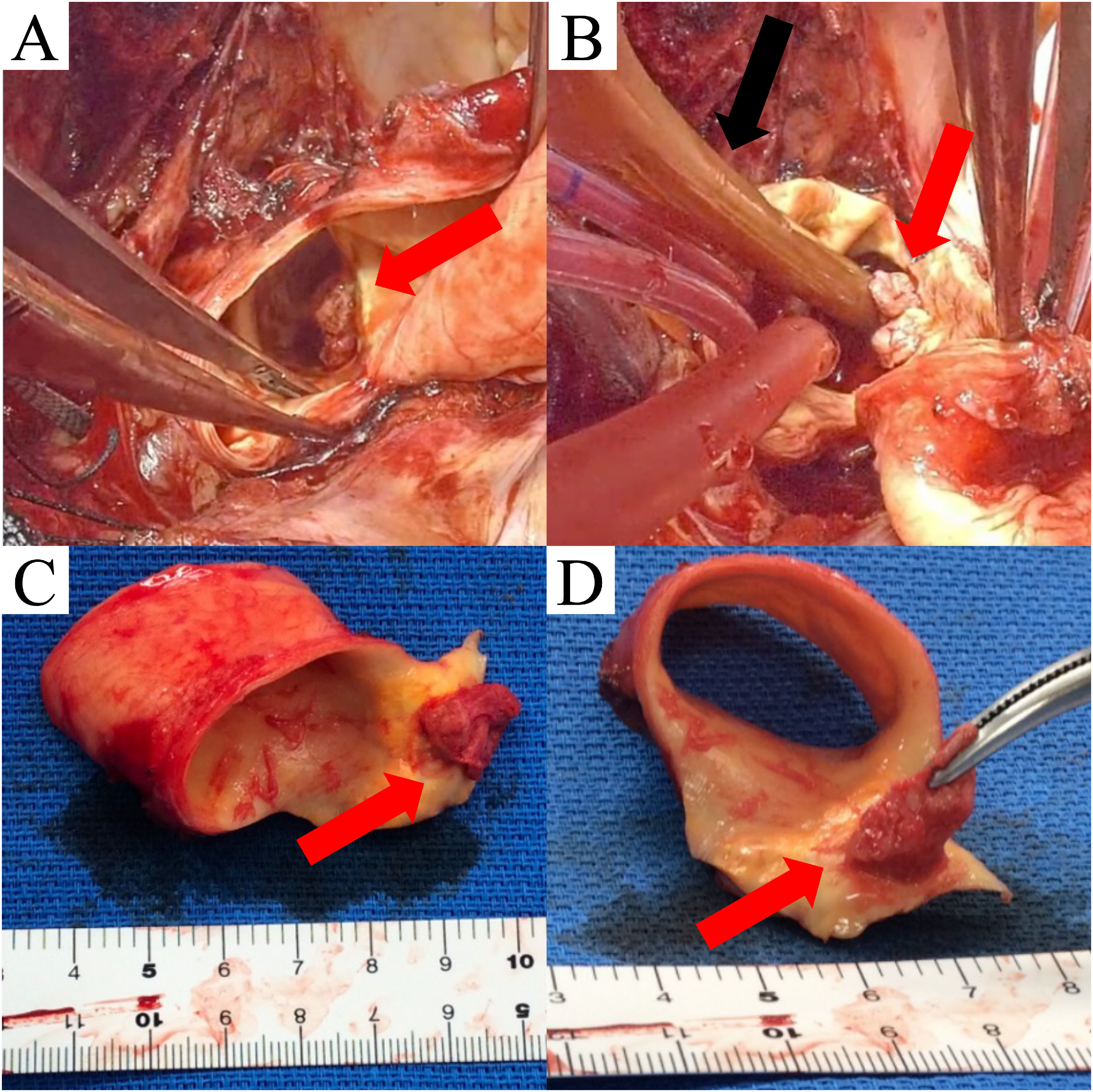 Fig. 2 Intraoperative findings. (A, B) The red arrows show that the mass is located on the lesser curvature side of the aortic arch. The black arrow shows a 14 Fr Foley catheter inserted to prevent the mass from falling to the peripheral side. (C, D) The resected aortic wall and mass.