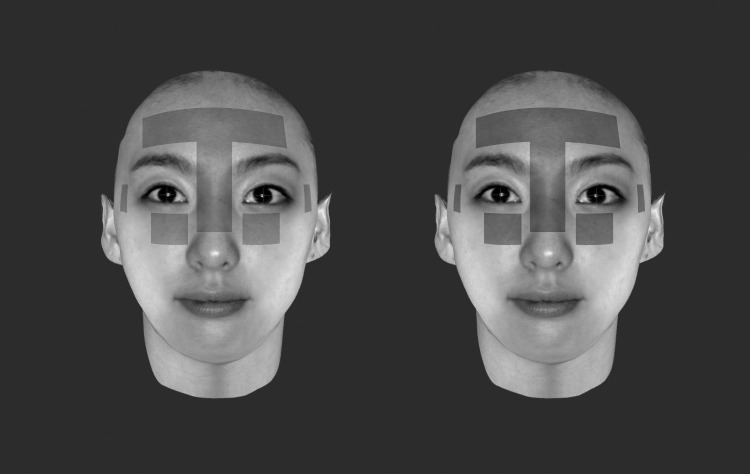 Figure 2. Superimposition of photographs taken before and after removal of orthodontic brackets. The locations of pupil and nose tip points, left and right foreheads, bridge of the nose, temple, and area below the eyes are auto-detected.