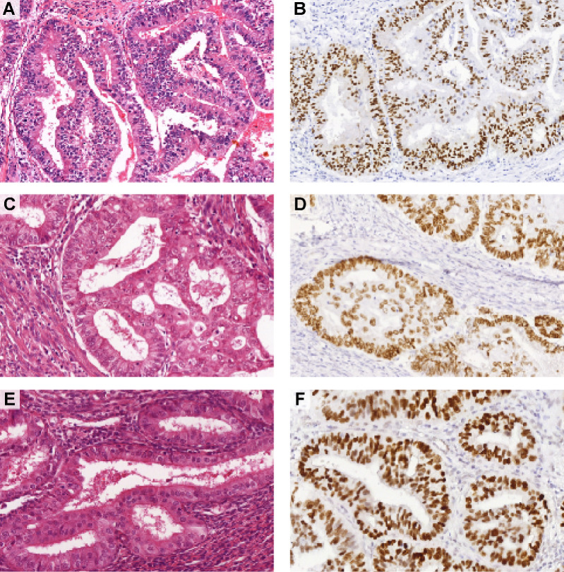 Figure 3. Three representative examples of p53abn low-grade (grade 1–2) EEC. H&E slides (A, C, E) and p53 IHC (B, D, F) of three cases diagnosed as low-grade endometrioid by at least three of the expert pathologists upon blinded pathology review. Note the glandular architecture, smooth luminal borders, and presence of only mild to moderate nuclear atypia.