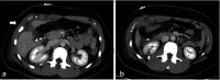 Images in a 27-year-old female victim was stabbed in the right mid abdomen by her boyfriend. (a) Axial abdomen CT scan demonstrates an AAST (American Association for the Surgery of Trauma) grade 2 liver laceration (arrowhead) with a small perihepatic hematoma (asterisk), and subcutaneous emphysema (arrow) at the site of stab injury. (b) Additional axial CT abdomen image demonstrated irregular hypoattenuation in the inferior aspect of left kidney, representing an AAST grade 2 laceration. The patient underwent surgical repair of liver laceration and cholecystectomy. The renal injury was managed conservatively.
