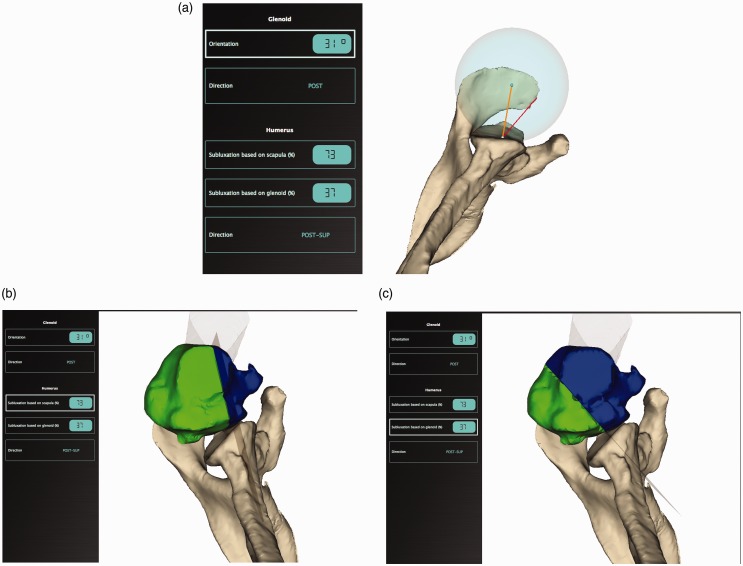 Is the Walch B3 glenoid significantly worse than the B2? - PMC