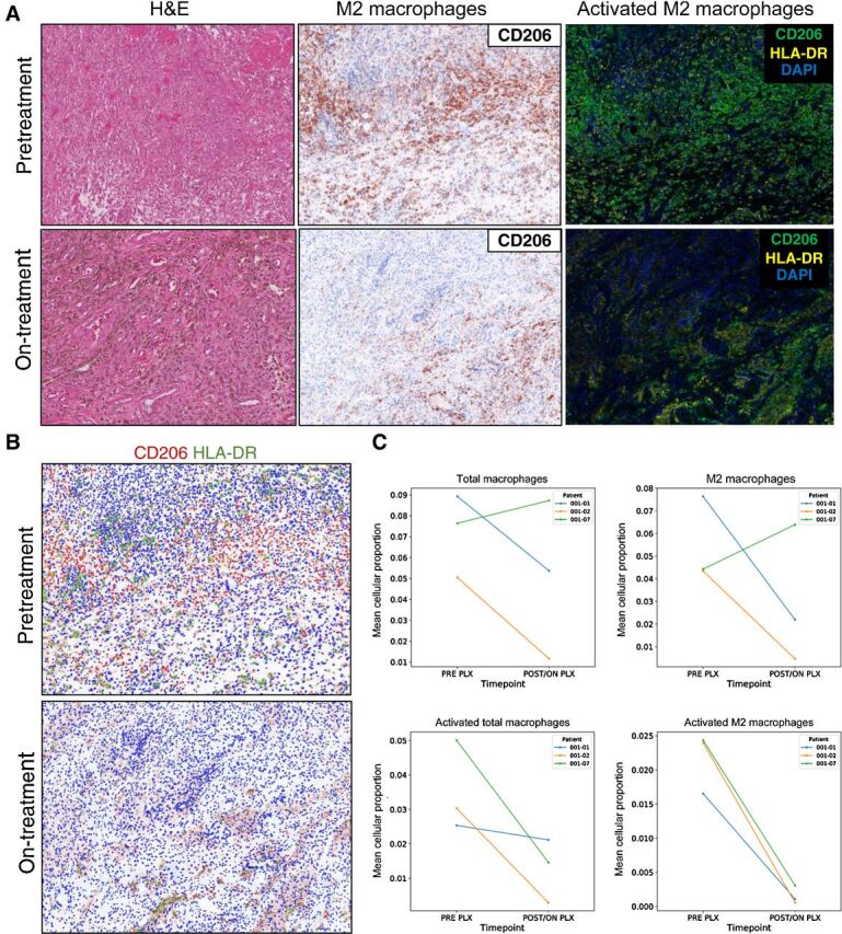 Figure 3. Activated M2 macrophages in tumor tissue. Treatment with pexidartinib and sirolimus resulted in a decrease in both CD206 expressing cells and CD206 and HLA-DR coexpressing cells. A, Pretreatment (top row) and on-treatment (bottom row) sections obtained from a patient with TGCT stained with H&E (left column), antisera against CD206 (middle column), and qmIF staining of both CD206 and HLA-DR (right column), with pexidartinib plus sirolimus. B, Scoring of pre- and on-treatment tumor tissue from a patient with TGCT for CD206 and HLA-DR using inForm (Perkin-Elmer) scoring of CD206 (red) and HLA-DR (green). C, Graphs depict non-statistically significant trends in total and activated macrophages (left column) and total and activated M2 macrophages (right column).