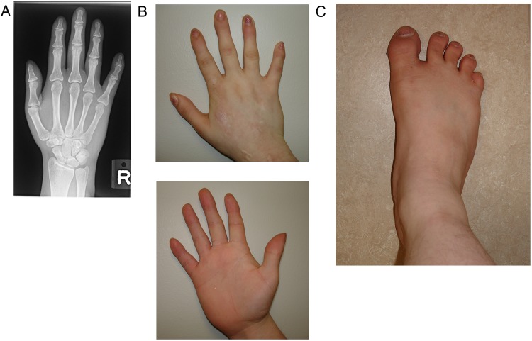 A fourth case of Feingold syndrome type 2: psychiatric presentation and ...