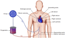 Subxiphoid tunneled cannulation approach