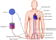 Peripheral ECMO cannulation approach