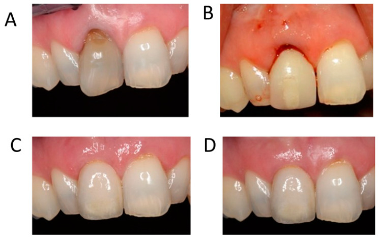 Preprosthetic Surgery—Narrative Review And Current Debate - PMC