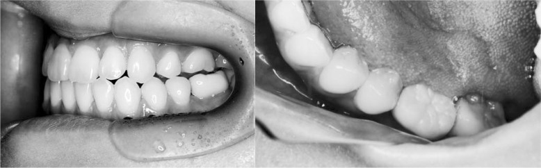 Figure 10. Intraoral photographs of the transplanted tooth 3 years after autotransplantation.