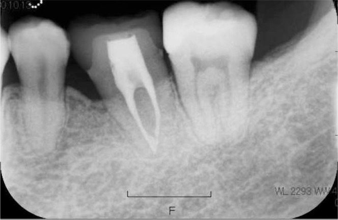 Figure 11. Dental radiograph of the transplanted tooth 3 years after autotransplantation.