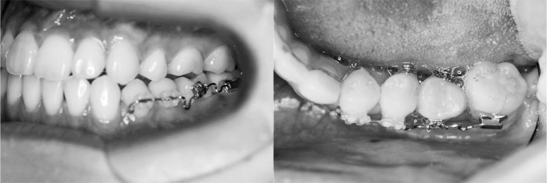 Figure 9. Intraoral photographs of the transplanted tooth, which was started to upright by a sectional arch 1 month after autotransplantation.