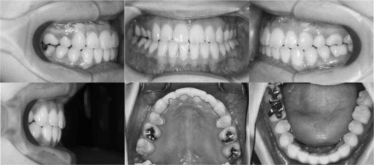 Figure 4. Posttreatment intraoral photographs.