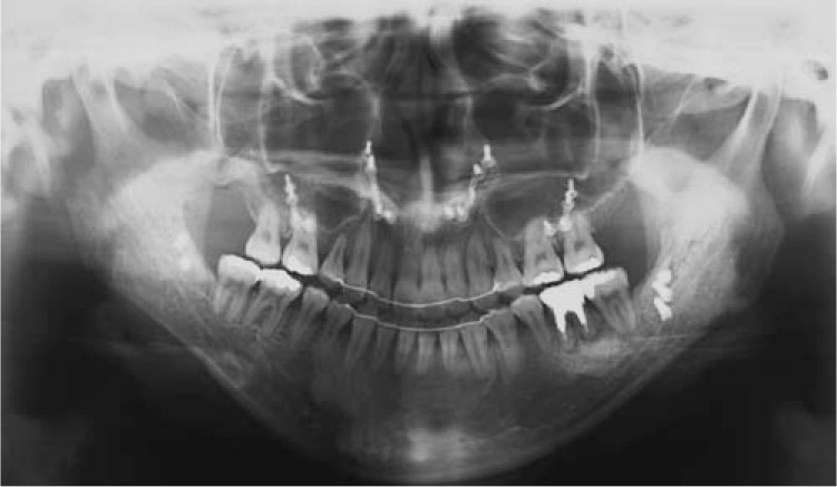 Figure 6. Posttreatment panoramic radiograph.