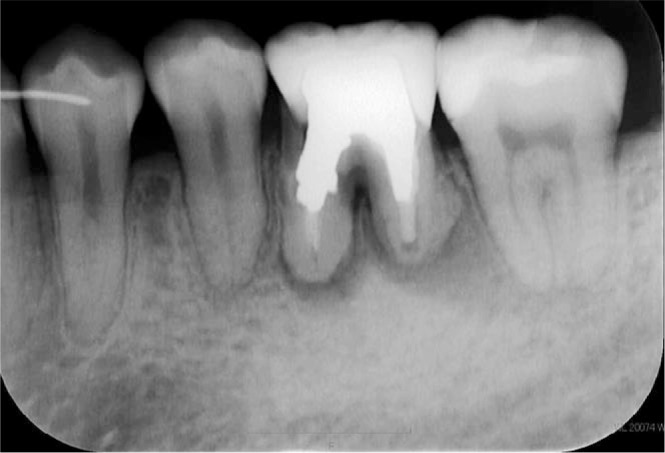 Figure 7. Dental radiograph of the lower left first molar 6 years after the initial visit.