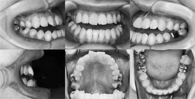 Figure 2. Pretreatment intraoral photographs.