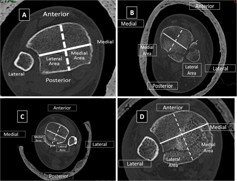 Preoperative planning and surgical technique for optimizing internal ...