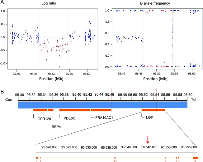 LGI1 microdeletion in autosomal dominant lateral temporal epilepsy - PMC