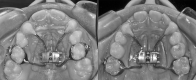 Figure 1. (a) Haas-type RME banded on upper second deciduous molars. (b) Haas-type RME banded on upper first permanent molars.