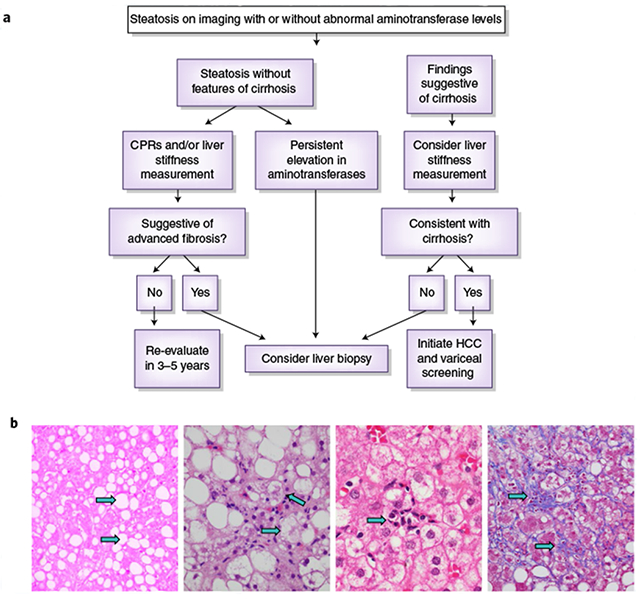 Histologic features of human NASH.