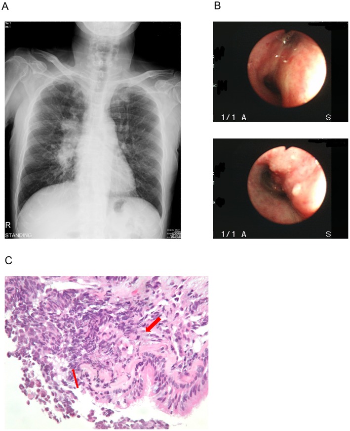 Endobronchial Mucosa Invasion Predicts Survival in Patients with Small ...