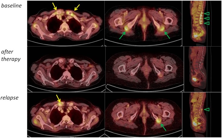18F FDG PET CT In Polymyalgia Rheumatica a Pictorial Review PMC 18f-fdg-pet-ct-in-polymyalgia-rheumatica-a-pictorial-review-pmc