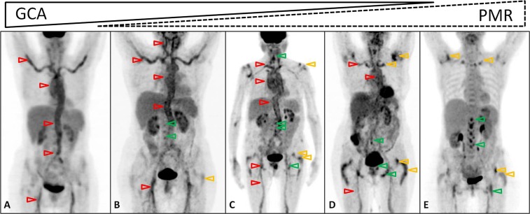 18f-fdg-pet-ct-in-polymyalgia-rheumatica-a-pictorial-review-pmc