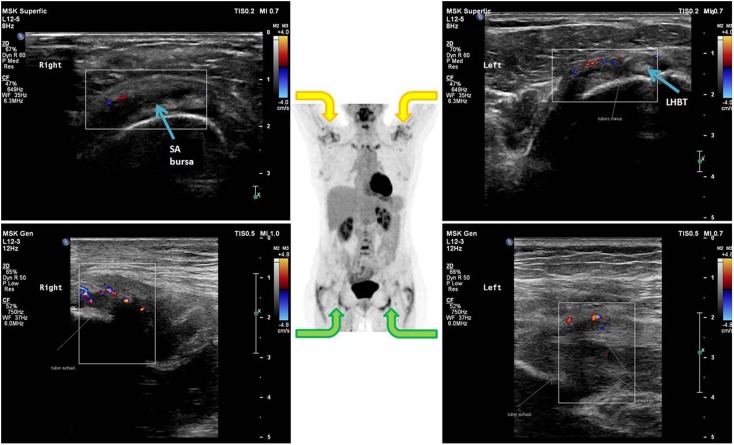 18F FDG PET CT In Polymyalgia Rheumatica a Pictorial Review PMC 18f-fdg-pet-ct-in-polymyalgia-rheumatica-a-pictorial-review-pmc