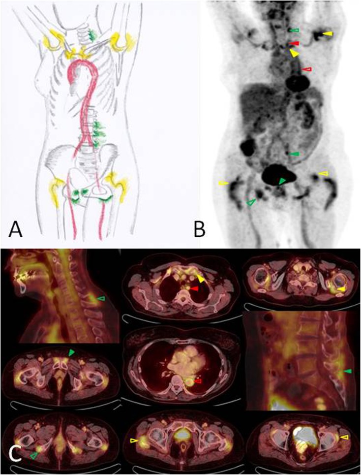 18F FDG PET CT In Polymyalgia Rheumatica a Pictorial Review PMC 18f-fdg-pet-ct-in-polymyalgia-rheumatica-a-pictorial-review-pmc