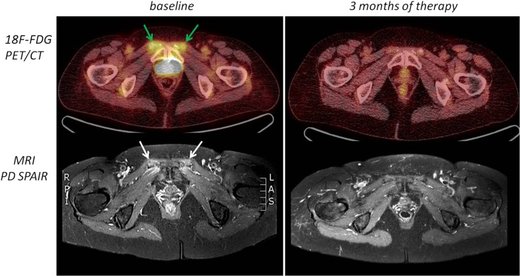 18F FDG PET CT In Polymyalgia Rheumatica a Pictorial Review PMC 18f-fdg-pet-ct-in-polymyalgia-rheumatica-a-pictorial-review-pmc