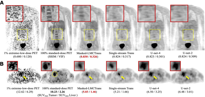 Qualitative results of Masked-LMCTrans (multimodality coattentional convolutional neural network transformer) with comparison models: single-stream transformer, U-Net-4, and U-Net-2. (A) Representative posttreatment fluorine 18 (18F) fluorodeoxyglucose (FDG) PET/MRI scan in a 14-year-old male patient with Hodgkin lymphoma from the primary cohort. The spine structure is completely missed by the other models but recovered by Masked-LMCTrans, although not perfectly, whereas the 1% PET is extremely noisy. (B) Representative posttreatment 18F-FDG PET/MRI scan in a 19-year-old female patient with Hodgkin lymphoma from the primary cohort. Tumor-to-liver maximum standardized uptake value (SUVmax tumor/SUVmax liver) contrast is preserved in all reconstructions. The reconstructions for the unresolved tumor (as the yellow circle indicates in 100% standard-dose PET) from models of the transformer family (Masked-LMCTrans and single-stream transformer) resemble that of 100% PET in terms of structural fidelity. SSIM = structural similarity index measure, VIF = visual information fidelity.