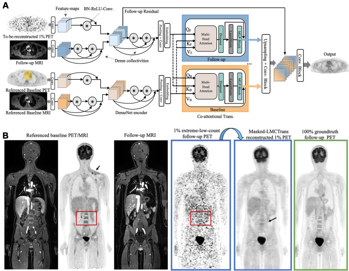 Proposed Masked-LMCTrans (multimodality coattentional convolutional neural network transformer) for 1% extremely ultra-low-dose PET/MRI reconstruction. (A) Framework of Masked-LMCTrans. The referenced baseline PET (with tumor area masked out as covered in the yellow mask) and MRI, along with the follow-up 1% PET/MRI scans, are fed into the model as combined inputs. The DenseNet feature encoder encodes PET and MRI separately before aggregation, with batch normalization, rectified linear unit, and 3 × 3 convolution (BN-ReLU-Conv) composite operations and dense collectivities. The coattentional transformer block fuses the information from the baseline and the follow-up (as indicated by the feature maps colored in orange and blue, respectively; the fused feature maps in the latter layers are mixed colored). The fusion is performed through baseline and follow-up information exchange by query, key, and value (denoted as Q, K, V). In this manner, Masked-LMCTrans reconstructs a 1% follow-up PET image, making use of the longitudinal similarity. (B) Representative posttreatment fluorine 18 fluorodeoxyglucose PET/MRI scan in a 14-year-old male patient with Hodgkin lymphoma. The contrast and structural details are significantly improved on Masked-LMCTrans–reconstructed PET as opposed to the simulated 1% PET. The red bounding box shows the spine anatomic structure, which is completely missing in the simulated 1% PET but successfully reconstructed by Masked-LMCTrans, with the help of the referenced baseline PET. The small tumor around the left supraclavicular region (arrow) in the baseline PET was resolved after treatment and was not shown on the reconstructed PET.