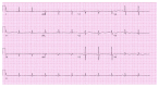 ECG exertional dyspnea & fatigue