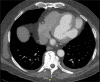 CT bilobed posterolateral left ventricular pseudoaneurysm