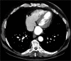 CT large bilobed posterolateral left ventricular pseudoaneurysm