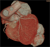 3-D CT reconstructed bilobed posterolateral LV pseudoaneurysm