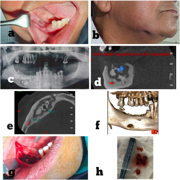 Osteomyelitis of Maxilla: A Rare Presentation Yet Not So Rare - PMC