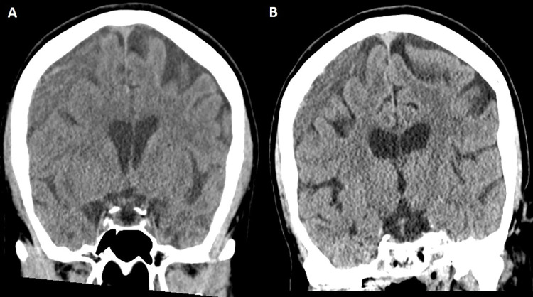 Case illustration of radiographic failure. (A) Head CT image in a 63-year-old woman shows a large right-sided chronic subdural hematoma (maximal thickness of 19 mm), which was discovered after the patient fell. Because of progressive headaches, the patient underwent a middle meningeal artery embolization procedure, which was uneventful. (B) Head CT image obtained at the 10-week follow-up (last available) shows minimal reduction of hematoma thickness, and the patient reported little improvement of headaches.